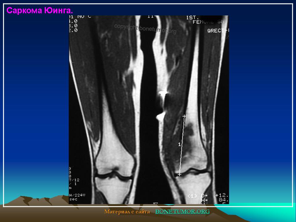 Саркома юинга симптомы. Саркома Юинга на верхней челюсти. Саркома Юинга большеберцовой кости кт.