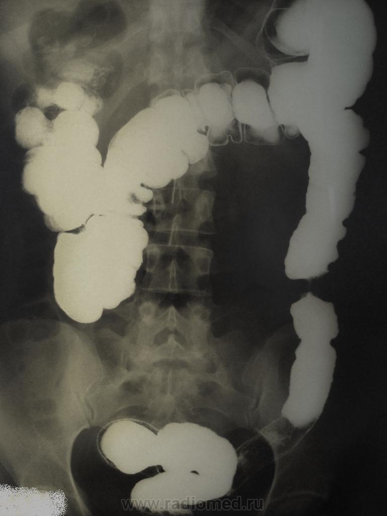 Ирригография кишечника. Дивертикулез ободочной кишки рентген. Непроходимость толстой кишки рентген. Злокачественная опухоль сигмовидной кишки рентген. Инвагинация Толстого кишечника рентген.