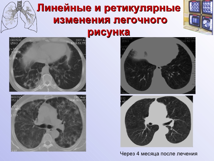 Фиброзно изменен легочный рисунок что это значит