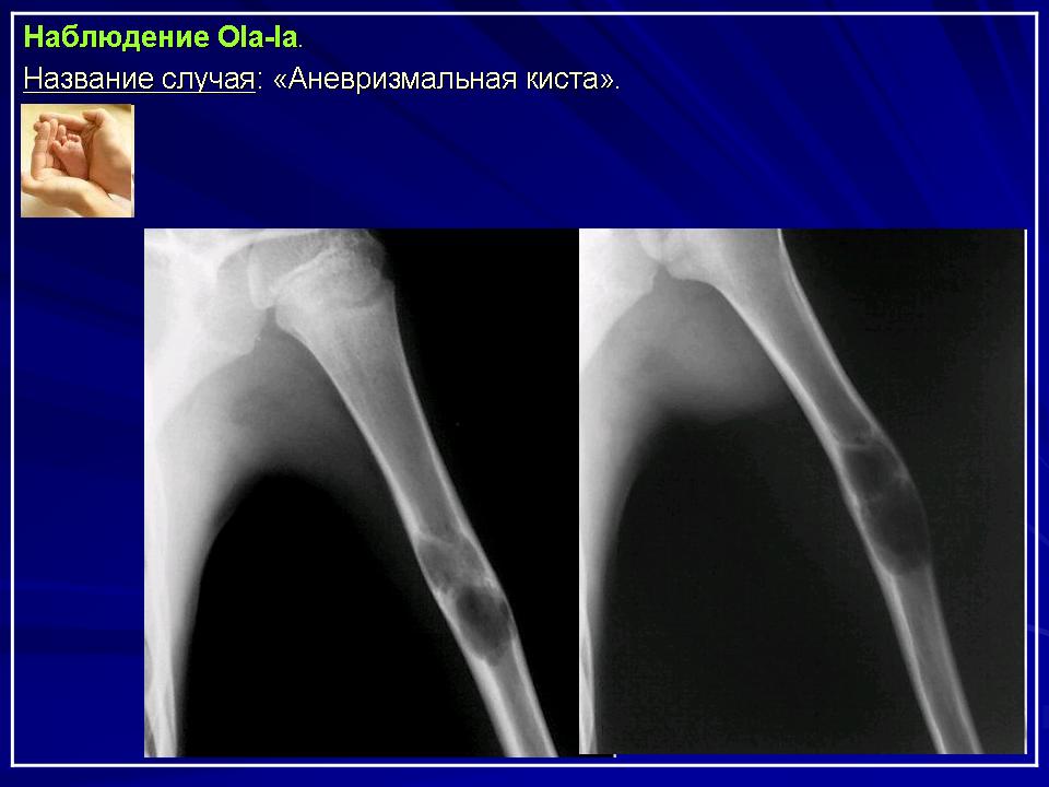 Костная киста. Аневризматическая костная киста рентген. Аневризматическая костная киста плечевой кости кт. Солитарная костная киста на кт.