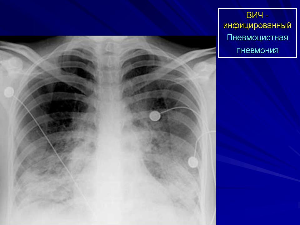 Пневмоцистоз. Рентген при пневмоцистной пневмонии. Пневмоцистная пневмония у ВИЧ рентген. Пневмоцистная пневмония рентгенологическая картина.