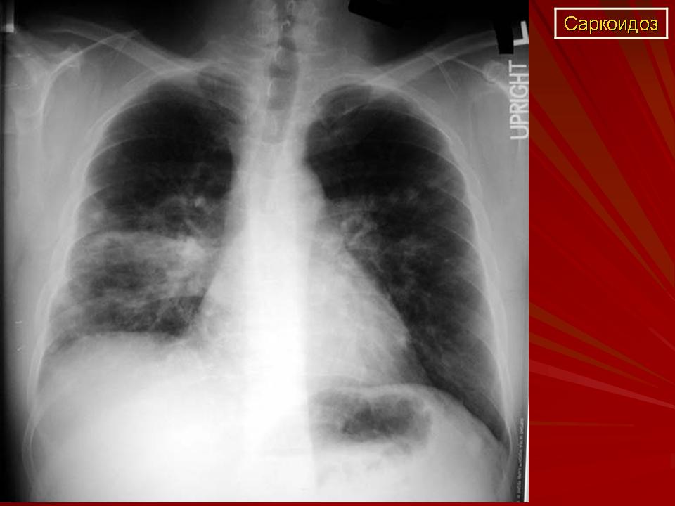 Саркоидоз это. Кольцевидный саркоидоз. Легочная форма саркоидоза.