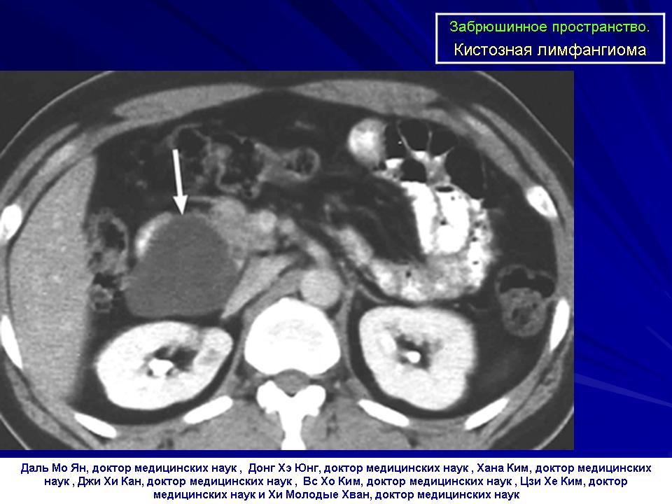 Забрюшинные неорганные саркомы. Мюллерова киста забрюшинного пространства кт. Образование забрюшинного пространства на кт. Киста забрюшинного пространства кт. Липосаркома забрюшинного пространства кт.
