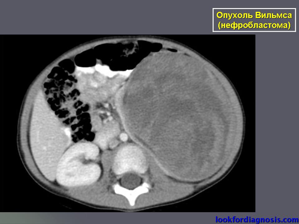 Нефробластома у детей. Нефробластома (опухоль Вильмса). Нефробластома почки кт. Эмбриональная нефробластома (опухоль Вильмса).