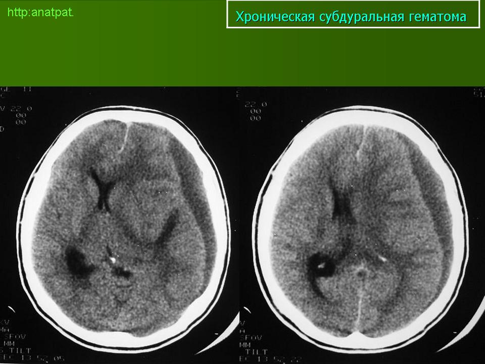 Гематома головного мозга рассасывается. Субдуральная гигрома головного мозга на кт. Субдуральная грома головного мозга кт. Субдуральная гематома лобно-височно-теменной области.