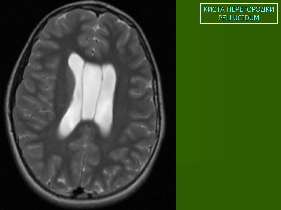 Полость прозрачной перегородки. Полость Верге мрт. Киста прозрачной перегородки полость Верге мрт. Киста Верге на кт. Желудочек Верге.