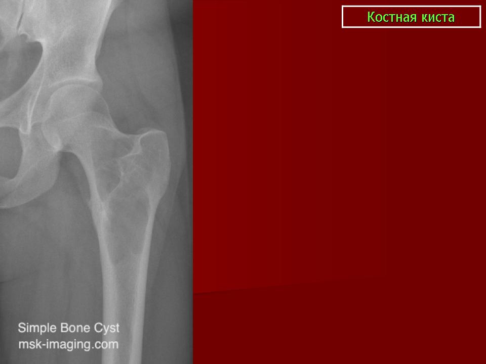 Киста костного мозга. Солитарная костная киста плечевой кости. Костная киста пяточной кости кт. Аневризматическая костная киста ребра.