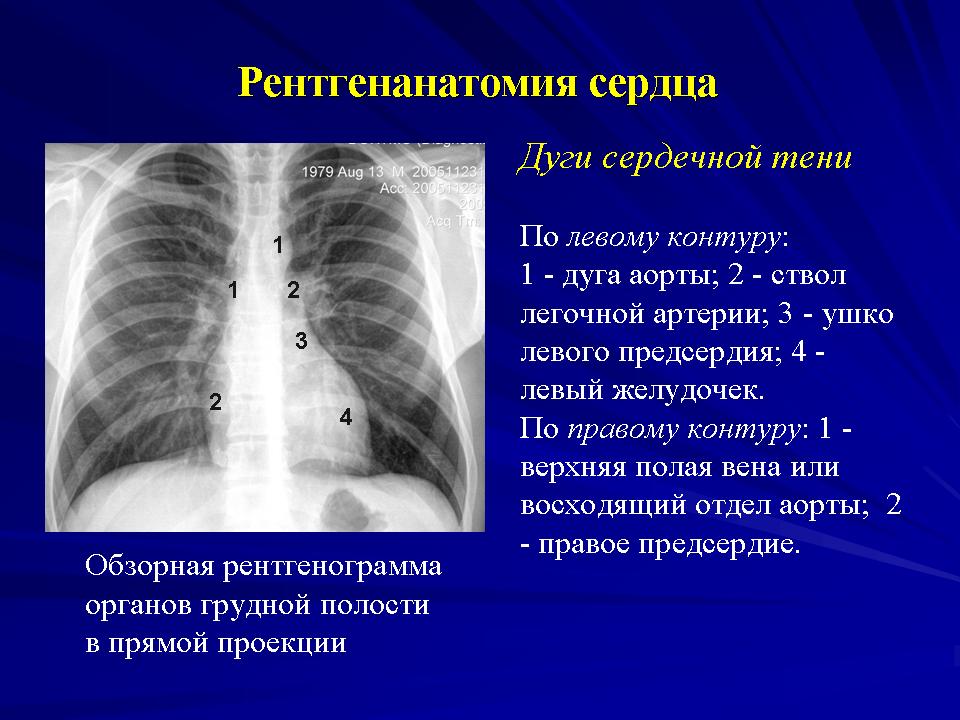 Сердце в рентгеновском изображении