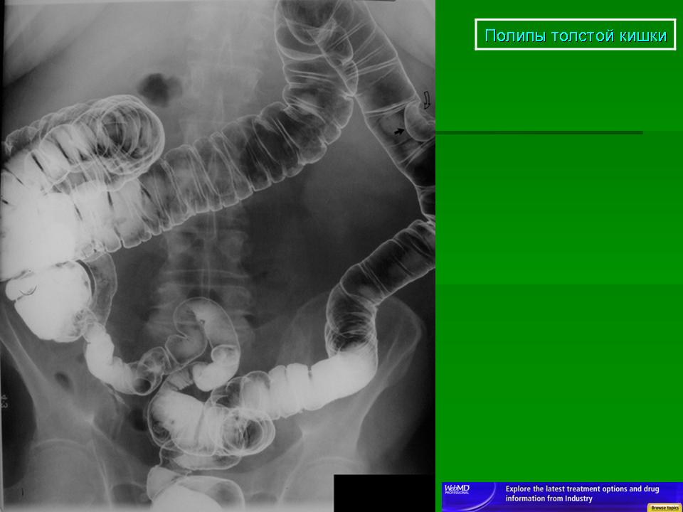 Трансверзоптоз кишечника. Ирригоскопия Толстого кишечника рентген. Полипы толстой кишки ирригоскопия. Ирригоскопия опухоль сигмовидной кишки. Ирригоскопия полипа кишечника.