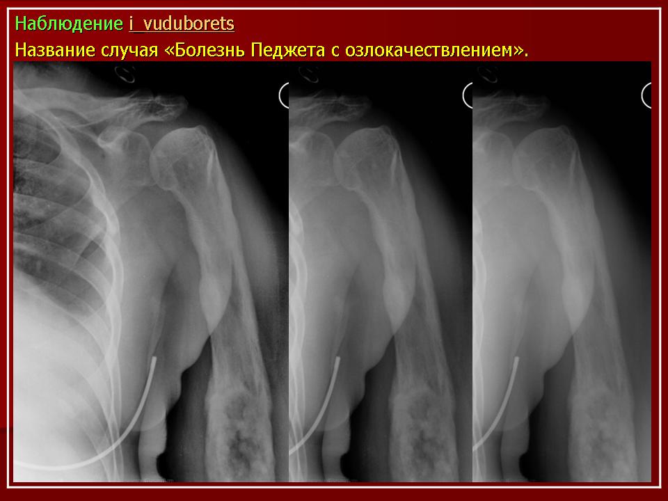 Костная болезнь. Остеодистрофия Педжета. Деформирующий остоз (болезнь Педжета).. Костная болезнь Педжета.