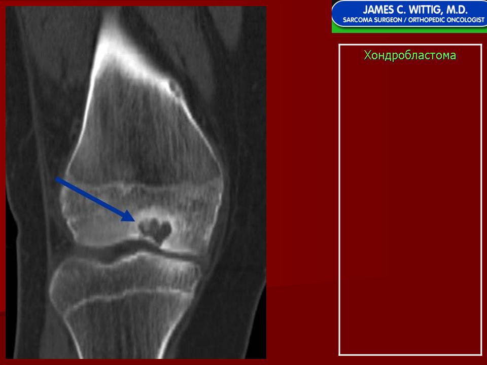 Киста большеберцового костя. Остеома коленного сустава мрт. Кт остеосаркома большеберцовой кости. Остеосаркома большеберцовой кости мрт. Гемангиома костей коленного сустава.