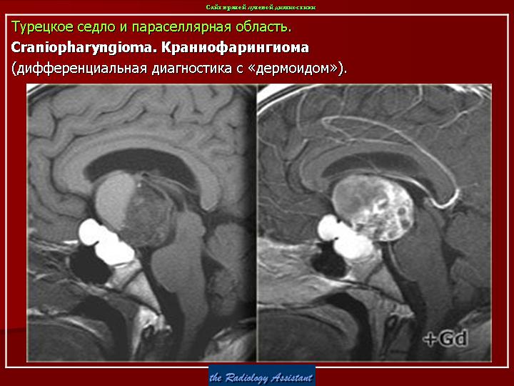 Седло в головном мозге. Аденома гипофиза краниофарингиома. Краниофарингиома турецкого седла. Краниофарингиома гипофиза мрт. Менингиома параселлярной области.