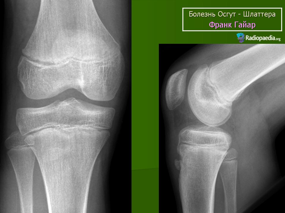 Бугристость костей. Болезнь Осгуд Шляттера рентген. Остеохондропатия надколенника (болезнь Синдинга-Ларсена-Иогансона). Осгуд Шлаттера рентген. Осгуд Шляттера рентген колена.
