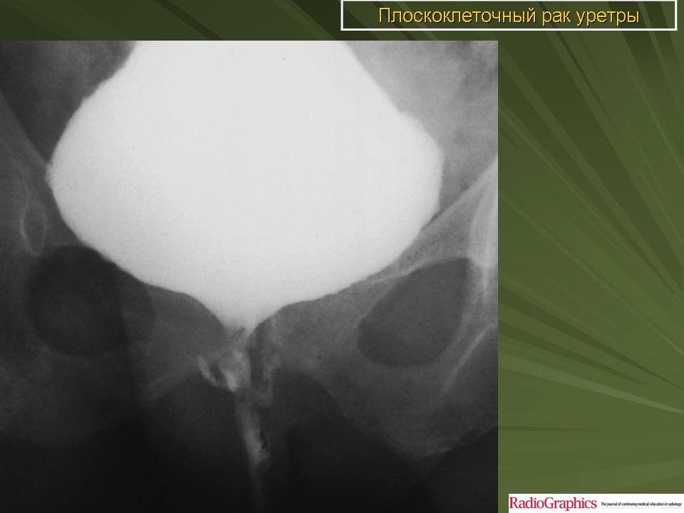 Уретра у мужчин где находится фото. Новообразование в уретре. Объемное образование уретры. Злокачественные опухоли уретры.