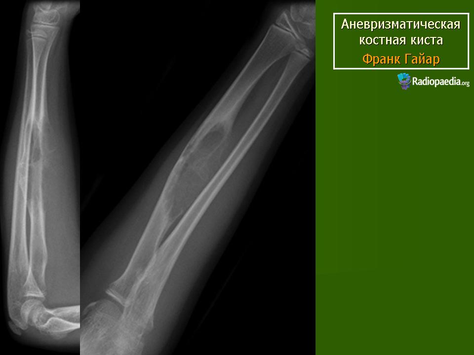 Операция кисты кости. Аневризматическая костная киста большеберцовой кости рентген. Аневризматическая киста бедренной кости на кт. Солитарная киста бедренной кости рентген. Аневризмальная киста бедренной кости рентген.