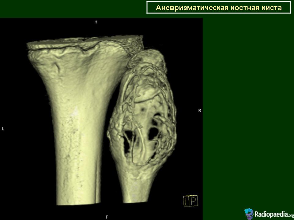 Киста кости. Аневризмальная костная киста рентген. Аневризмальная костная киста бедренной. Костная киста большеберцовой кости на кт. Аневризматозная киста кости.