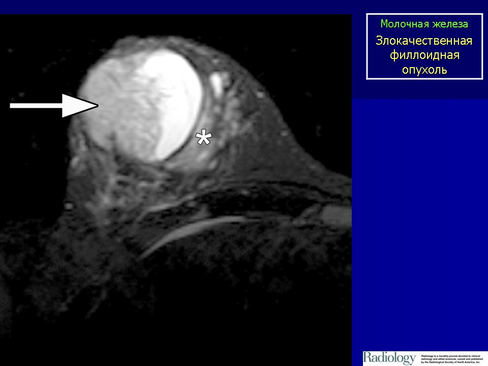 Злокачественная опухоль железы. Филлоидная фиброаденома. Листовидная фиброаденома молочной. Филлоидная (листовидная) опухоль. Филлоидная опухоль на УЗИ.