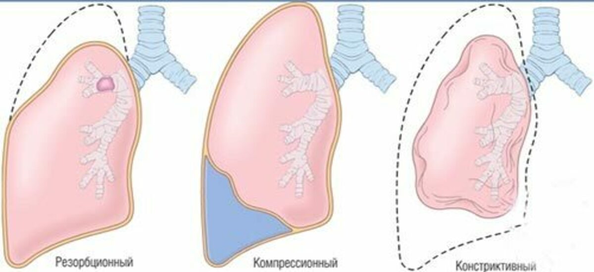 Ателектаз легкого. Компрессионный ателектаз легкого. Ателектаз механизм развития. Ателектаз легкого патогенез. Обтурационный ателектаз легкого.