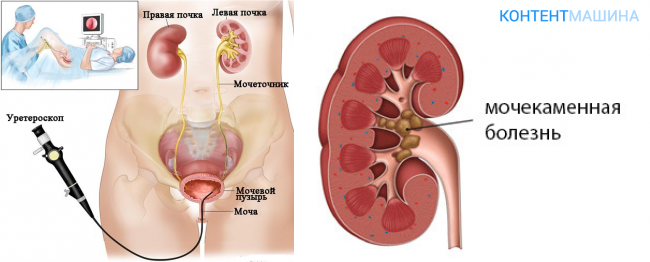 Камень в мочеточнике у женщин фото Мочекаменная болезнь камень мочеточника