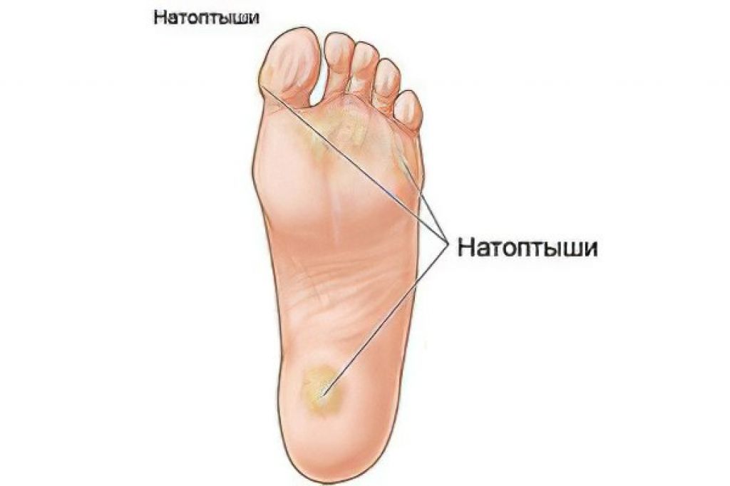 Кожа большого пальца ноги. Избавление от натоптышей на стопе. Внутренний натоптыш на ступне. Женские ступни с натоптышами.