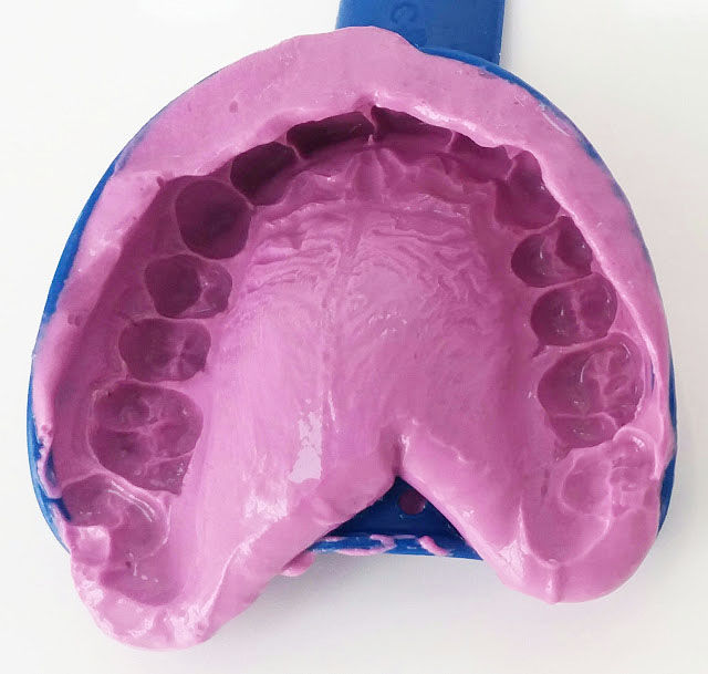 Оттиск в стоматологии. Альгинатный оттиск. Слепок верхней челюсти. Альгинатный слепок.