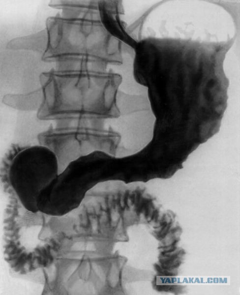 Рентген желудка с барием фото
