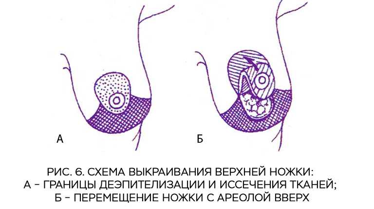 Мастопексия Цена