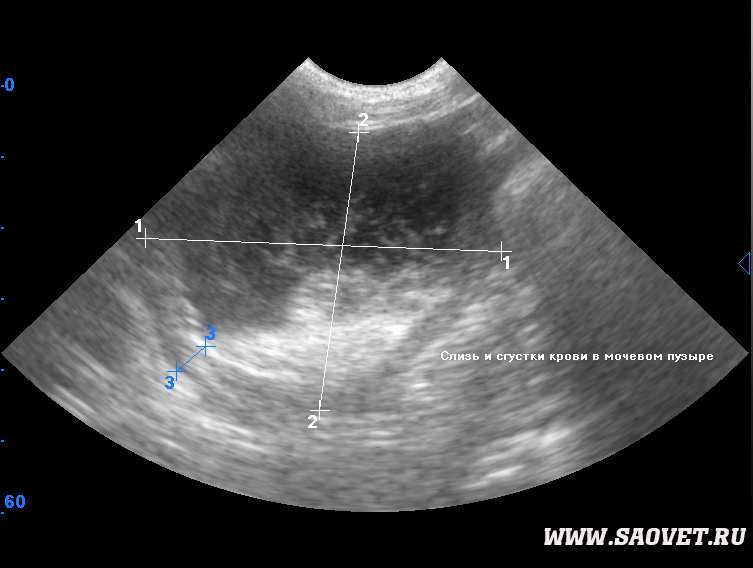 Как делают узи мочевого пузыря. Гемотампонада мочевого пузыря УЗИ. Цистит на УЗИ мочевого пузыря. Патология мочевого пузыря на УЗИ. Тампонада мочевого пузыря на УЗИ.