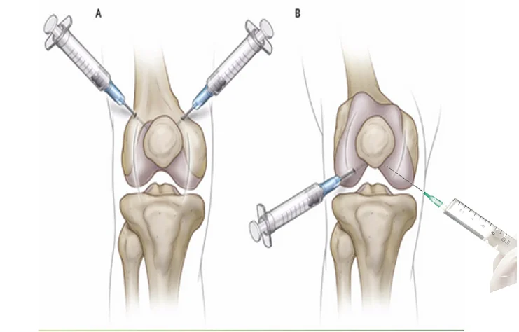 Можно в коленный сустав делать уколы. Пункция коленного сустава техника. Внутрисуставные блокады коленного сустава. Внутрисуставные инъекции в коленный сустав. Пункция коленного сустава операция.