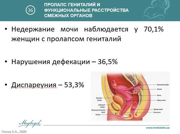 Опущение органов малого таза у женщин симптомы фото как выглядит