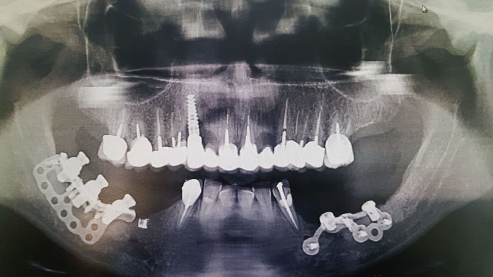 Сделать кт челюсти. Субпериостальная имплантация рентген. Кт нижней челюсти Волгоград. Заставка на рабочий стол кт челюстей. Субпериостальный пеплом челюсти.