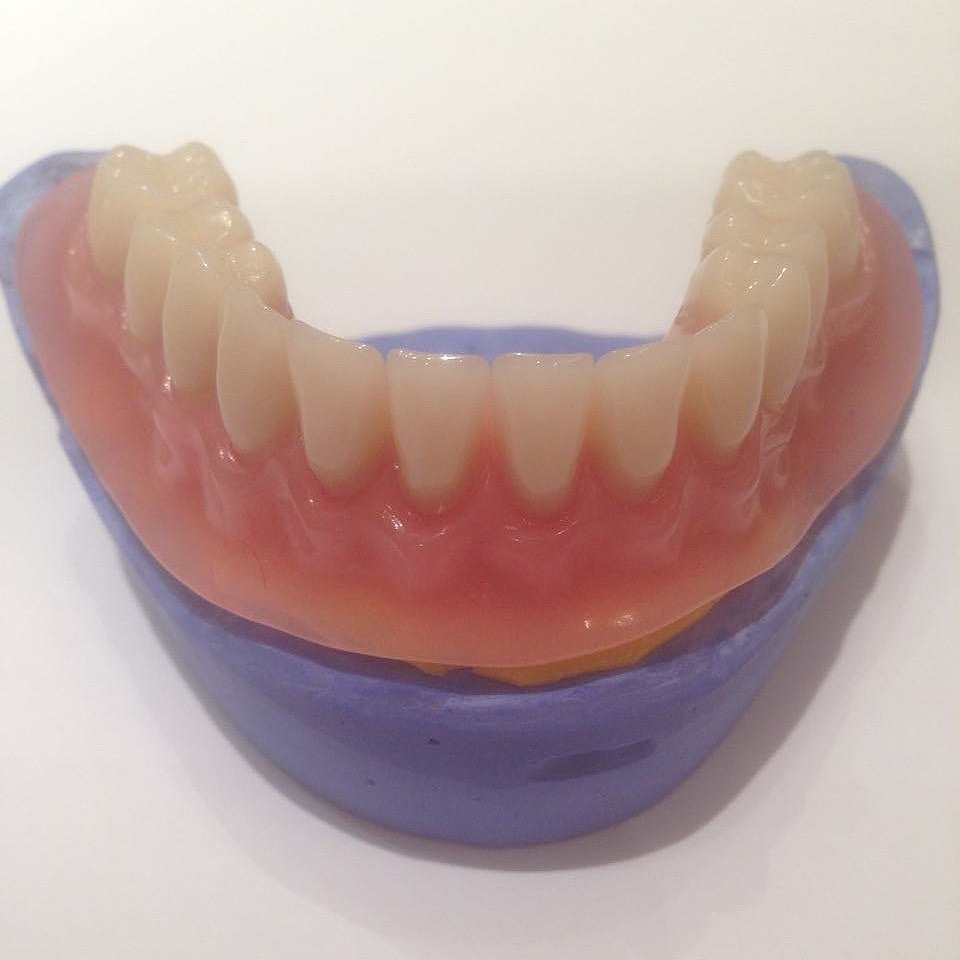 Какие зубные протезы лучше при отсутствии зубов. ПСП протез акриловый НЧ. Съемный протез (6-14 зубов) термо Джет. А23.07. 002.040 Полный съемный протез. Протезы нижней челюсти с моделировкой.