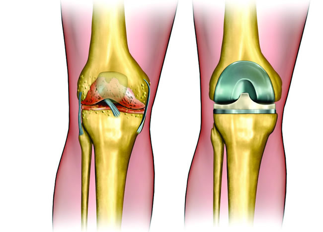 Операции на коленном суставе стоимость. Эндопротез мениска коленного сустава. Разрыв мениска коленного операция. Мениск менискэктомия. Имплант мениска коленного сустава.