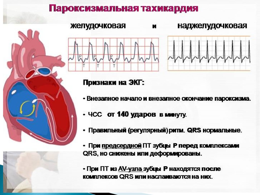 Резко сильное сердцебиение. Пароксизмальная тахикардия ЭКГ признаки. Пароксизмальная наджелудочковая тахикардия ЭКГ. ЭКГ при пароксизмальной тахикардии. Пароксизмальная желудочковая тахикардия на ЭКГ.