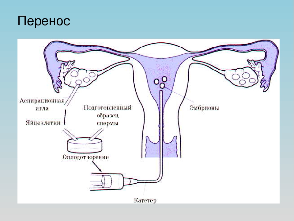 Перенос эмбрионов при эко. Схема экстракорпорального оплодотворения. Перенос эмбрионов в полость матки.