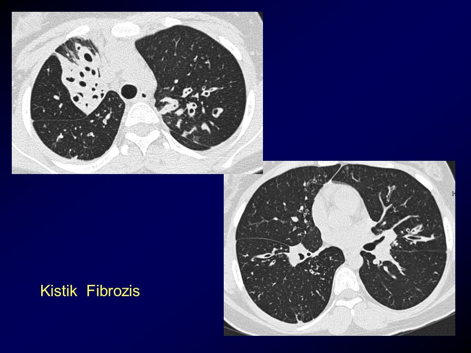 Кистозный фиброз. Kistik Fibroz transmembran o'tkazuvchanligi regulyatori [musculus].