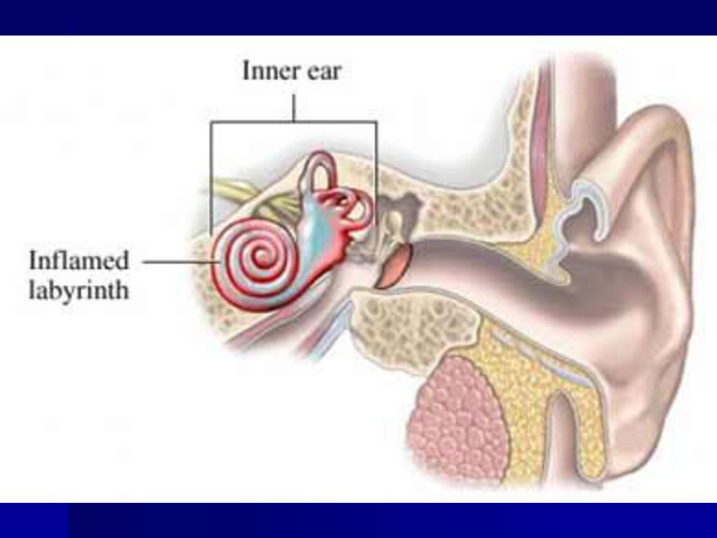 Заболевания внутреннего уха. Что такое лабиринтит внутреннего уха. Воспалительные заболевания внутреннего уха (лабиринтиты).. Болезнь внутреннего уха