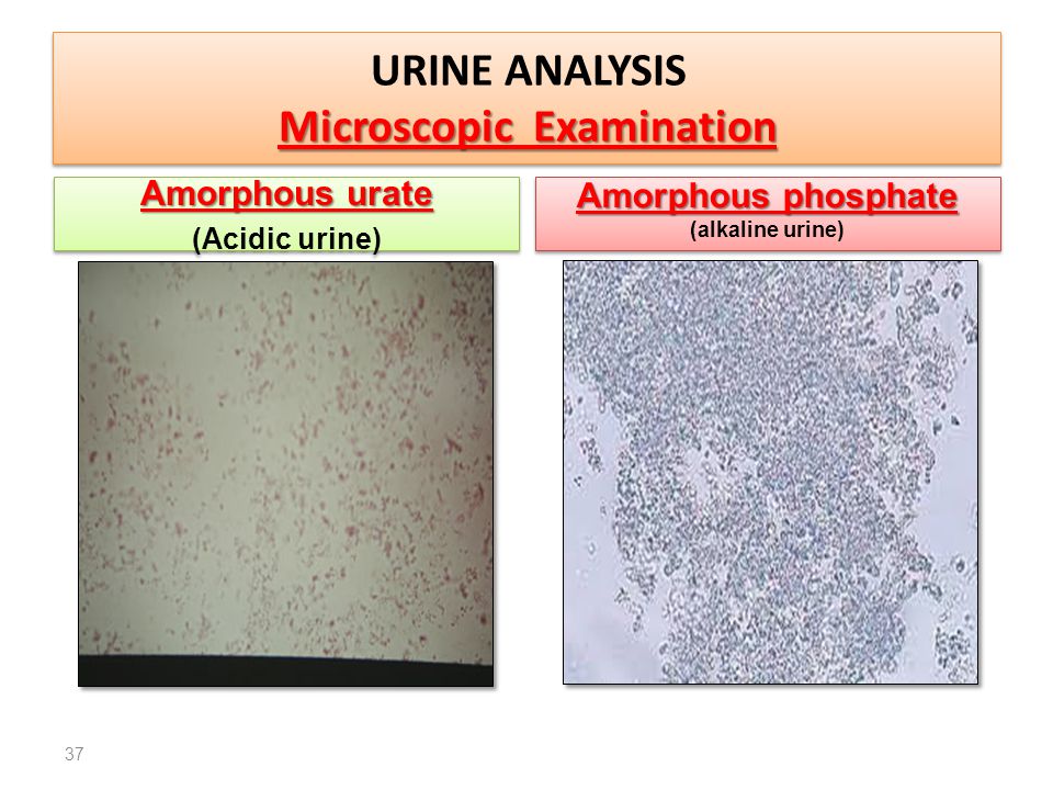 Аморфные фосфаты в моче фото под микроскопом