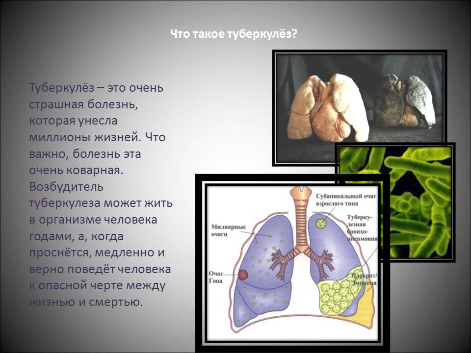 Туберкулез и сд презентация