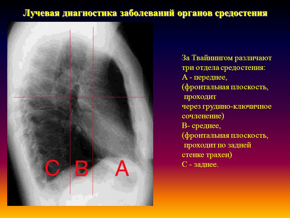 Лучевой диагноз. Образование верхнего средостения рентген. Объемное образование верхнего средостения. Этажи средостения на рентгене. Опухоли средостения рентген.