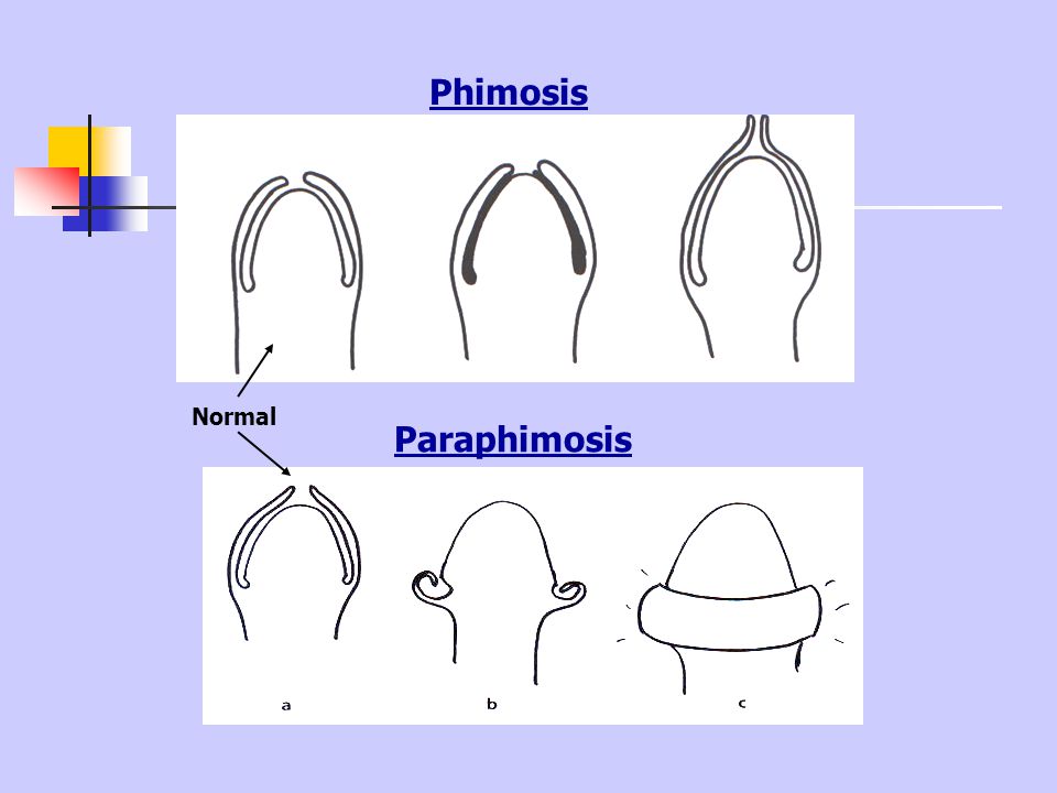 Что такое парафимоз. Стадии открытия головки. Фимоз и парафимоз у детей. Парафимоз стадии.