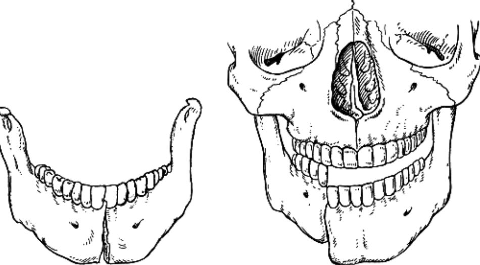 Проекция челюсти. Перелом нижней челюсти со смещением отломков. Травматический перелом нижней челюсти. Переломы нижней челюсти (в области ее ветви):. Оскольчатый перелом нижней челюсти.
