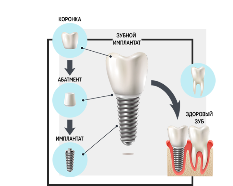 Сколько будет стоить поставить зуб имплант. Имплант винт абатмент коронка. Циркониевая коронка на имплант Osstem. Схема имплант абатмент коронка. Схема установки зубного имплантата.