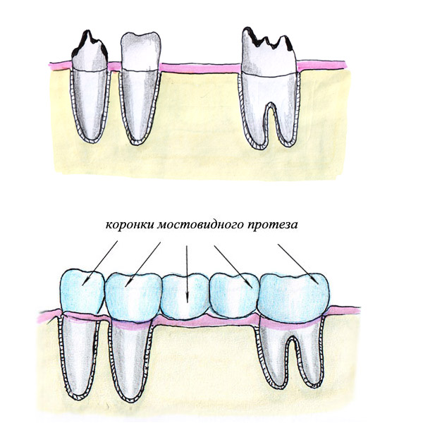 Виды мостовидных протезов