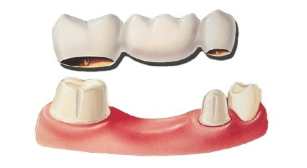 Несъемные мостовидные протезы