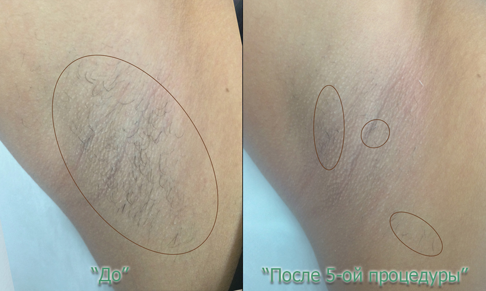 Бикини фото до и после лазерной эпиляции