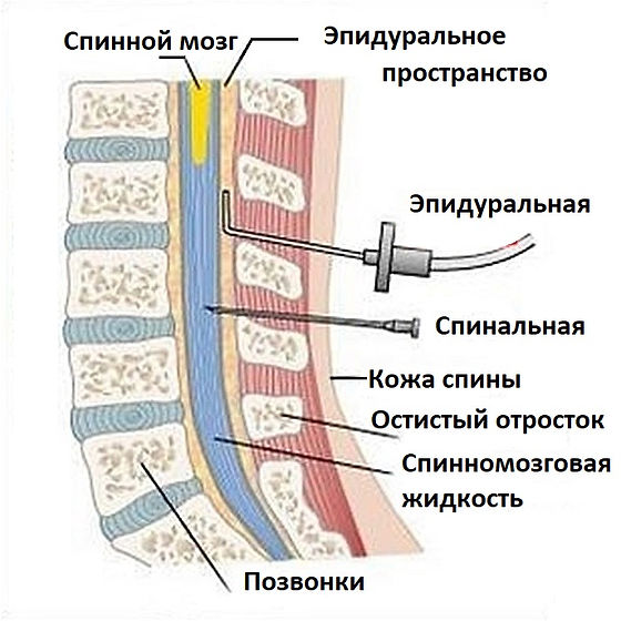 Эпидуральная спинная. Спинальная и эпидуральная анестезия. Эпидуральная анестезия строение. Эпидуральная анестезия дуральная. Эпидуральная анестезия капельница.