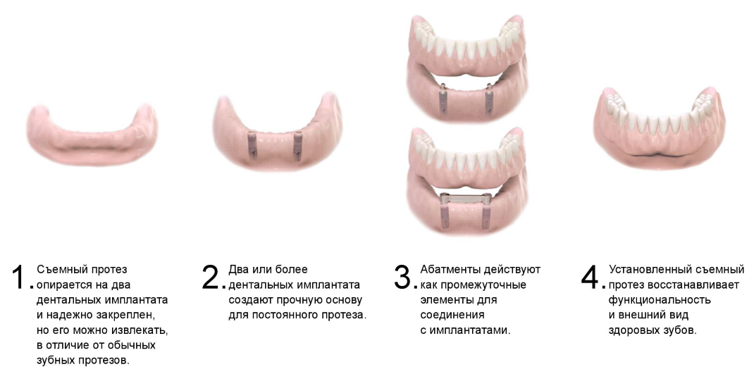 Как быстро привыкнуть к съемным зубным протезам. Имплантация зубов с неправильным прикусом. Привыкание к съемным зубным протезам. Заказ-наряд на полный съёмный протез.