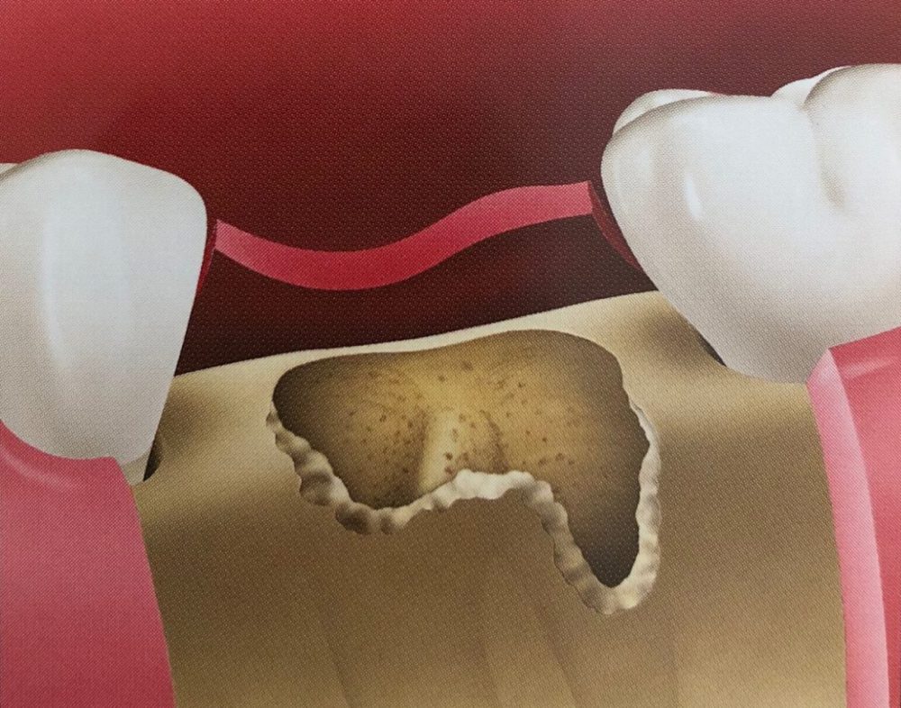 Восстановление костной ткани зубов. Альвеолит надкостницы.