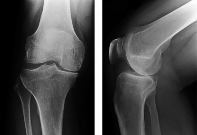 Сделать снимок сустава. Лигаментоз коленного сустава рентген. Артроз надколенника рентген. Рентгенограмма левого коленного сустава. Остеопойкилия коленного сустава рентген.